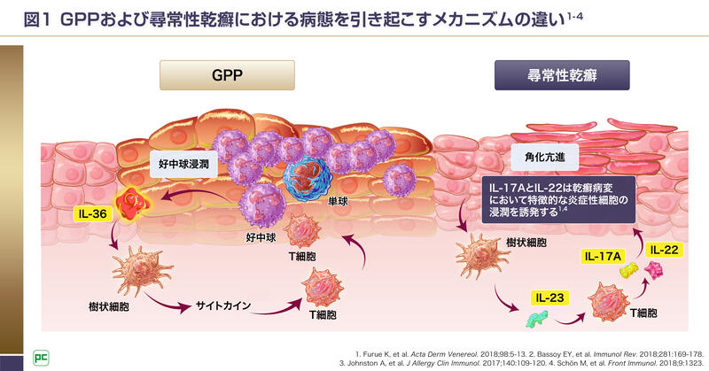GPPとPsVの病態の違い