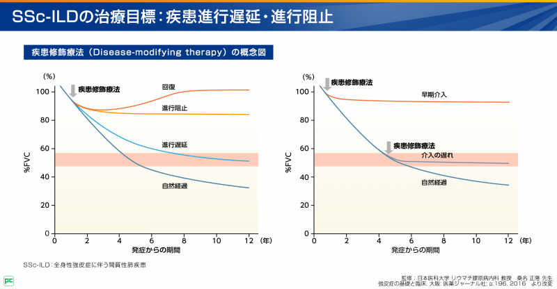 SSc-ILD診断の解説パート03