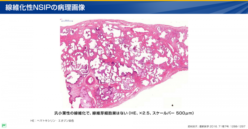特発性NSIPの組織学的所見02