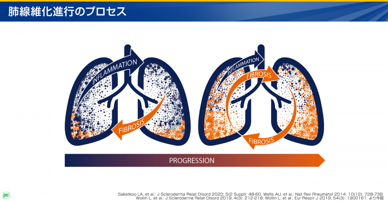 抗線維化薬による治療