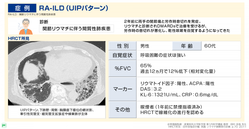 RA-ILD (UIPパターン)