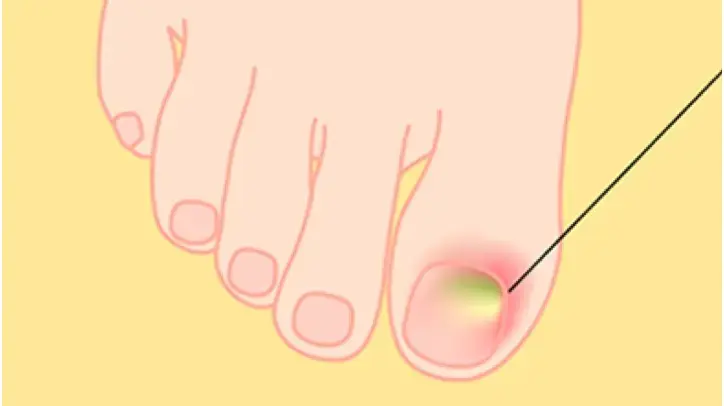 ジオトリフの副作用「爪囲炎」のイメージ